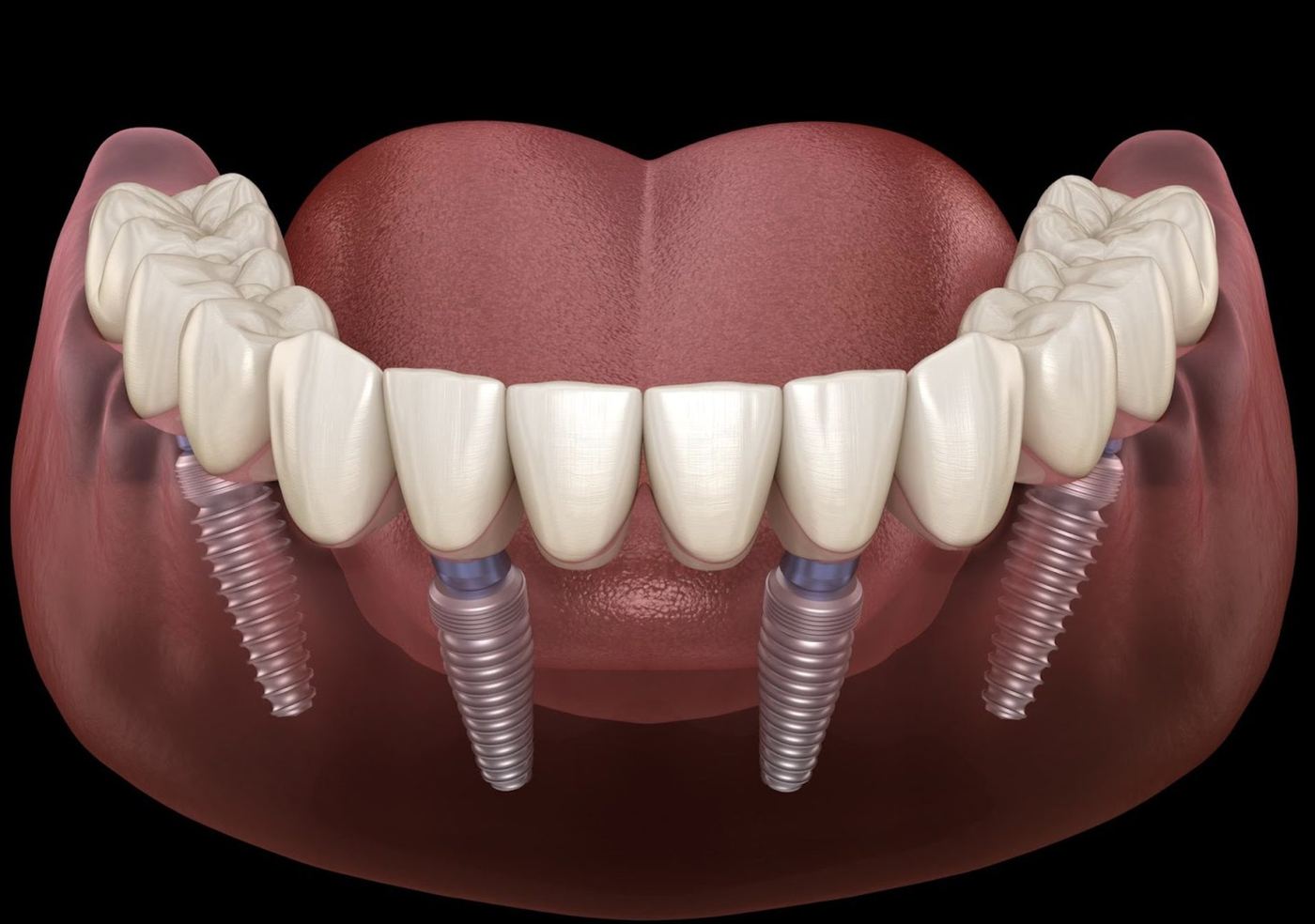 All-on-4 treatment illustration showing full-arch implant positions